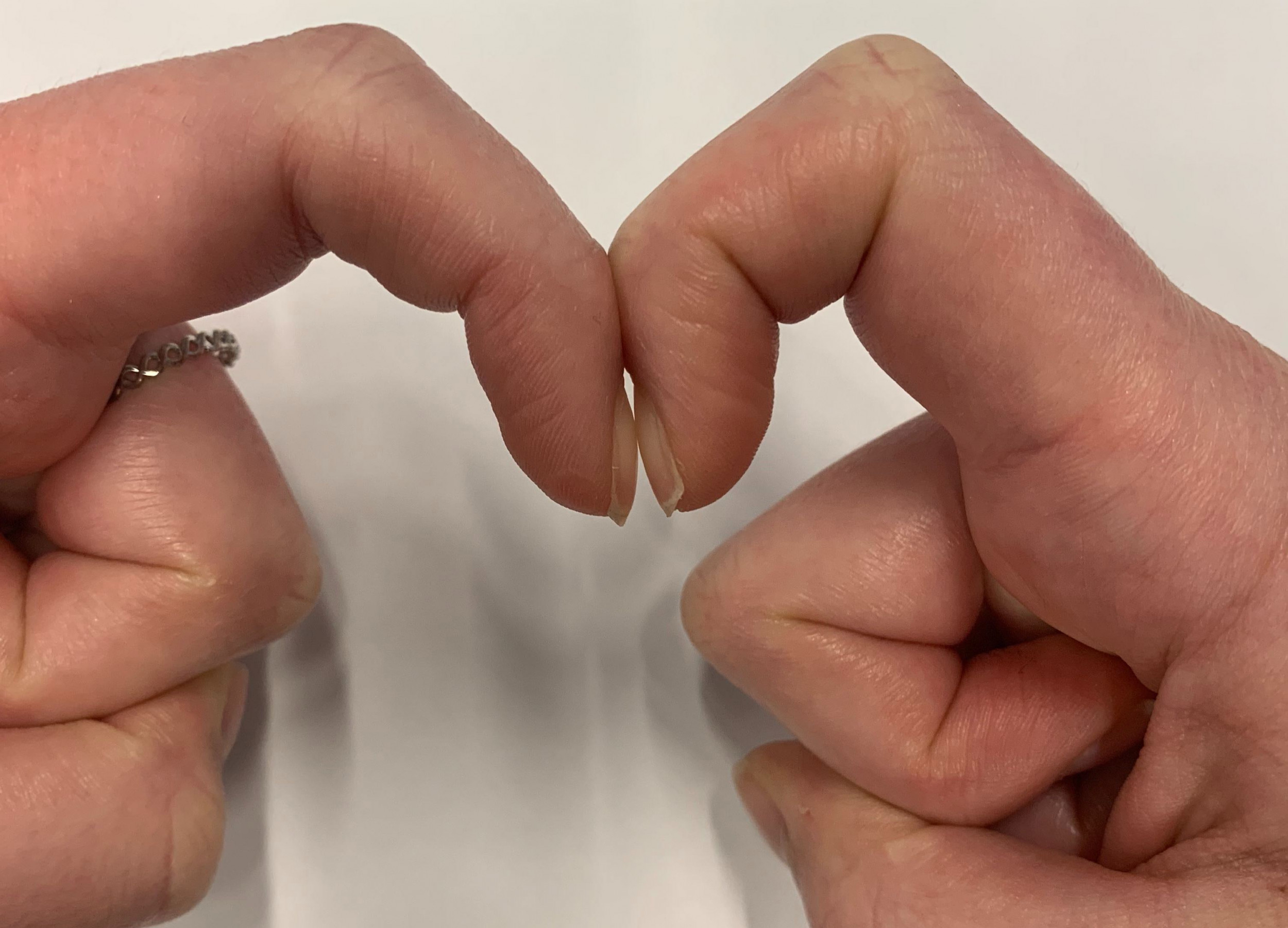 What precautions am I supposed to take after knowing that I have clubbed  nails? - Quora